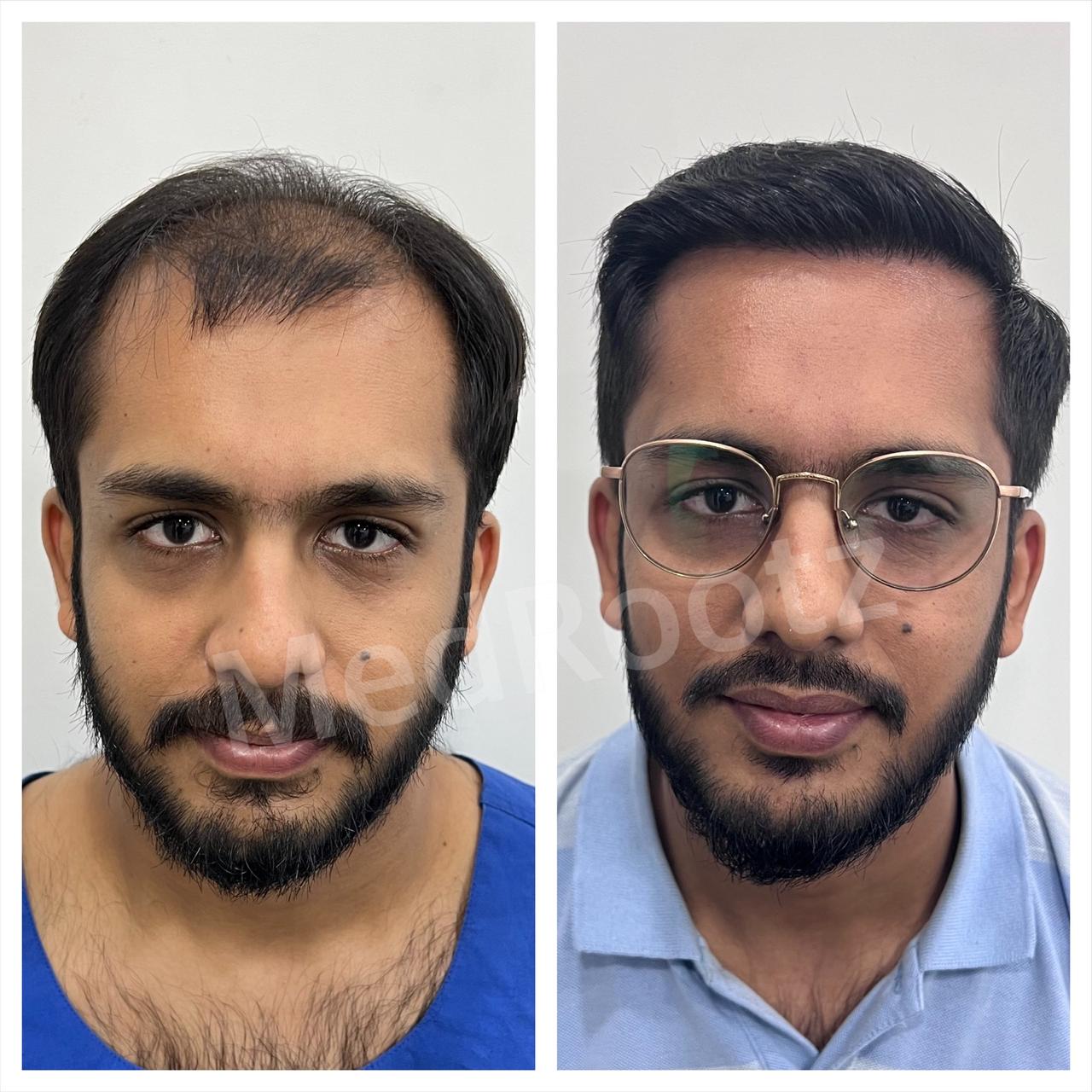 Nu-FUE hair transplant before and after, 5170 grafts