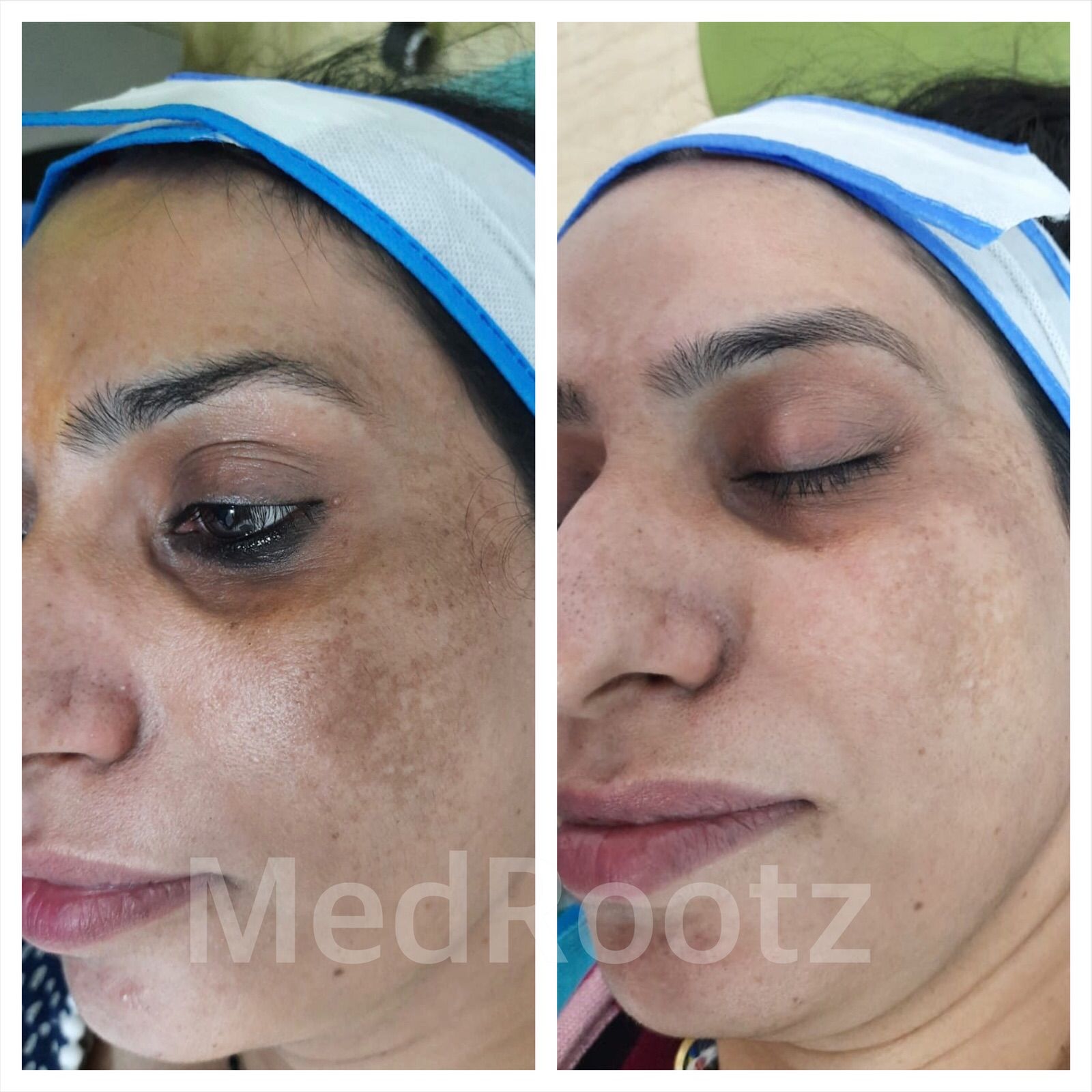 Skin care treatment at MedRootz clinic